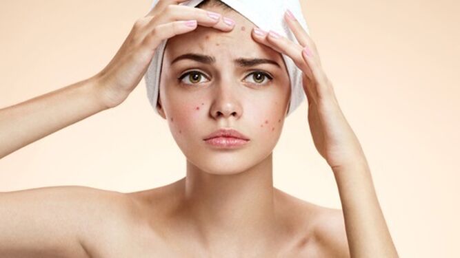 Sol y acné: ¿Es beneficioso para la piel?