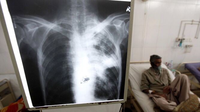 Un enfermo de tuberculosis reciben atención médica.