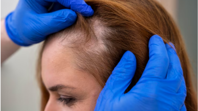 La relación entre el sedentarismo y la alopecia o pérdida de cabello