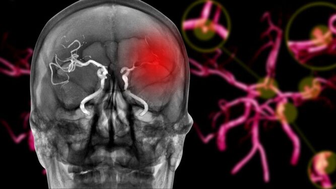 Aneurisma cerebral: estos son los síntomas que nos ponen en alerta