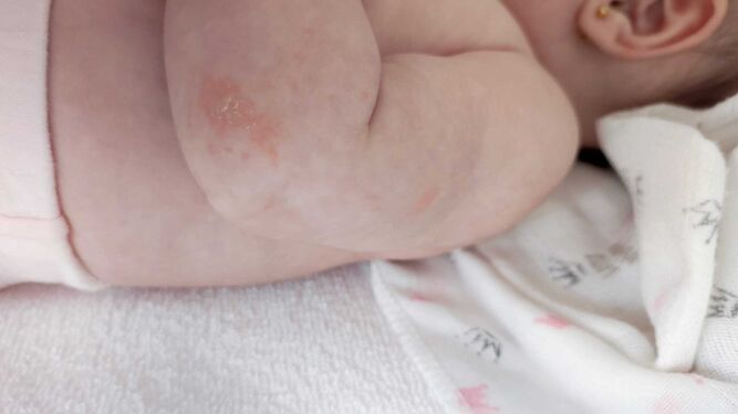 Una bebé, con un eczema en un brazo.
