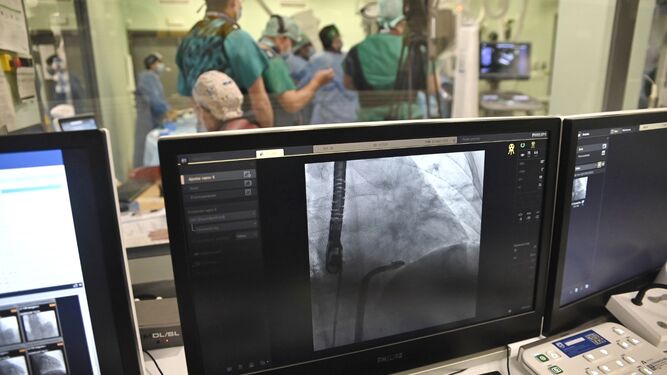 Un caso práctico de intervencionismo de la válvula tricúspide realizado en directo en el Hospital Reina Sofía de Córdoba.